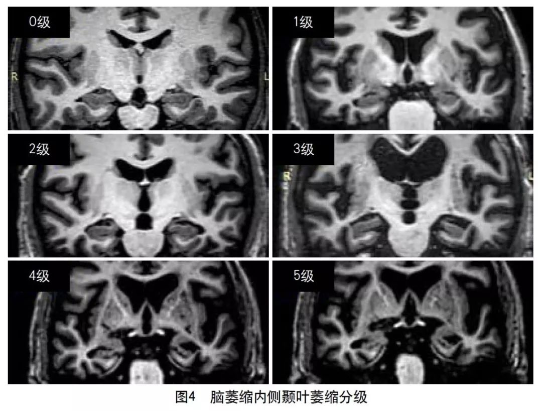 容易被误诊漏诊的脑小血管病,脑小血管病的基础知识