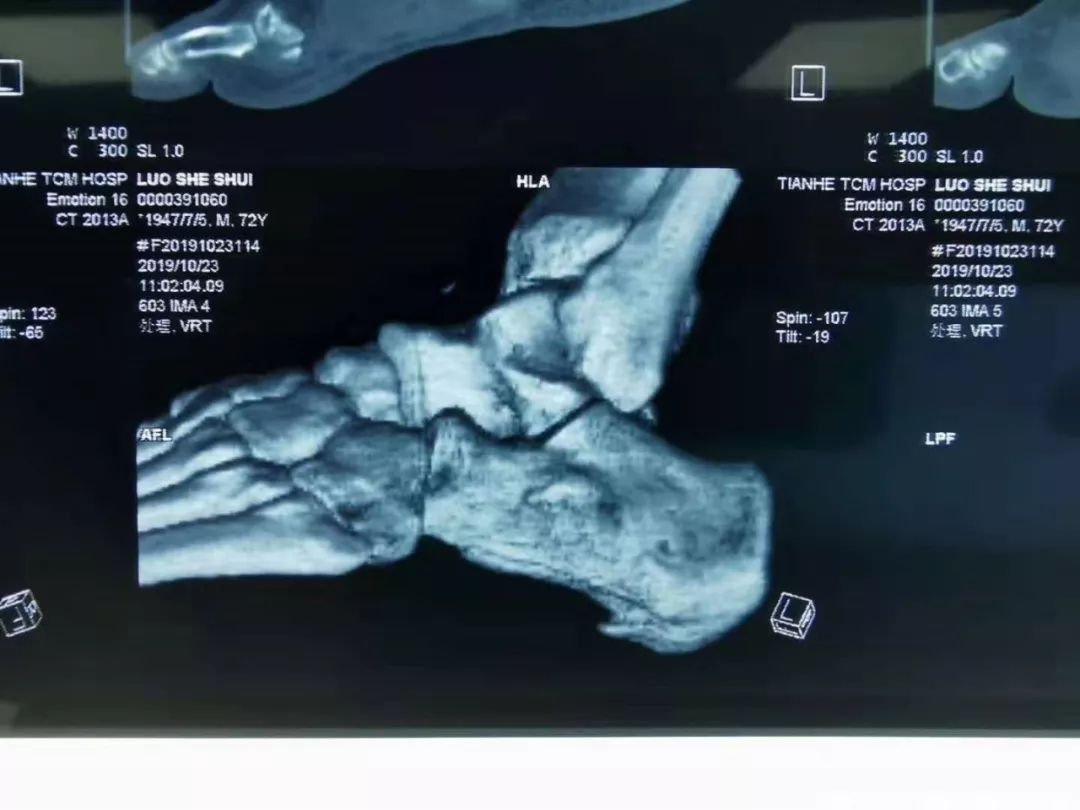 广州天河区中医院骨伤二科成功实施关节镜下跟骨骨刺摘除术