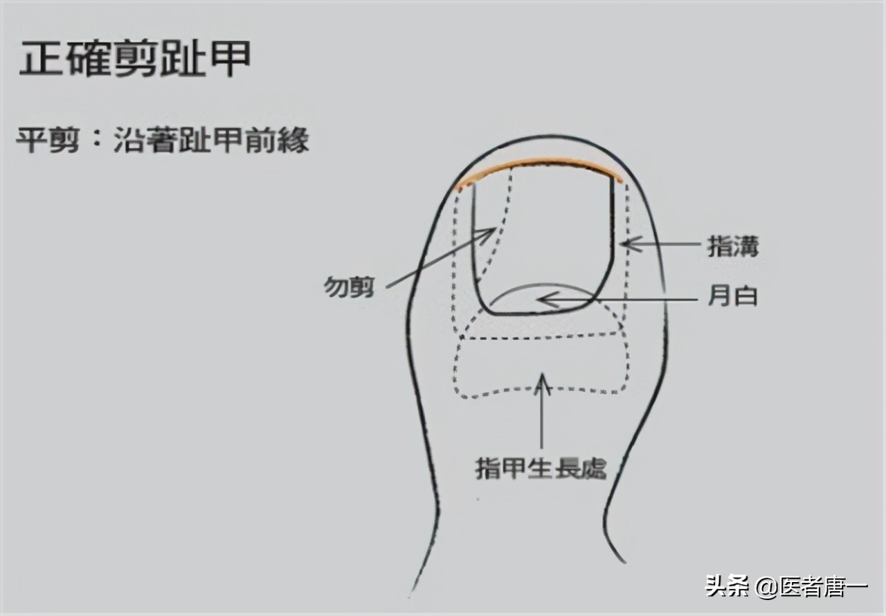 甲沟炎是不是治不好呀,甲沟炎对脚趾的伤害