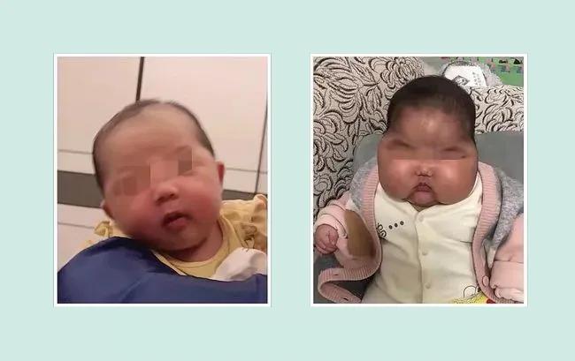 娃娃湿疹严重怎么治疗,怎么预防宝宝湿疹和皮疹