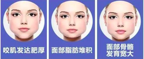 关于瘦脸针的小常识你都了解多少,瘦脸针人人都可以打吗科普篇