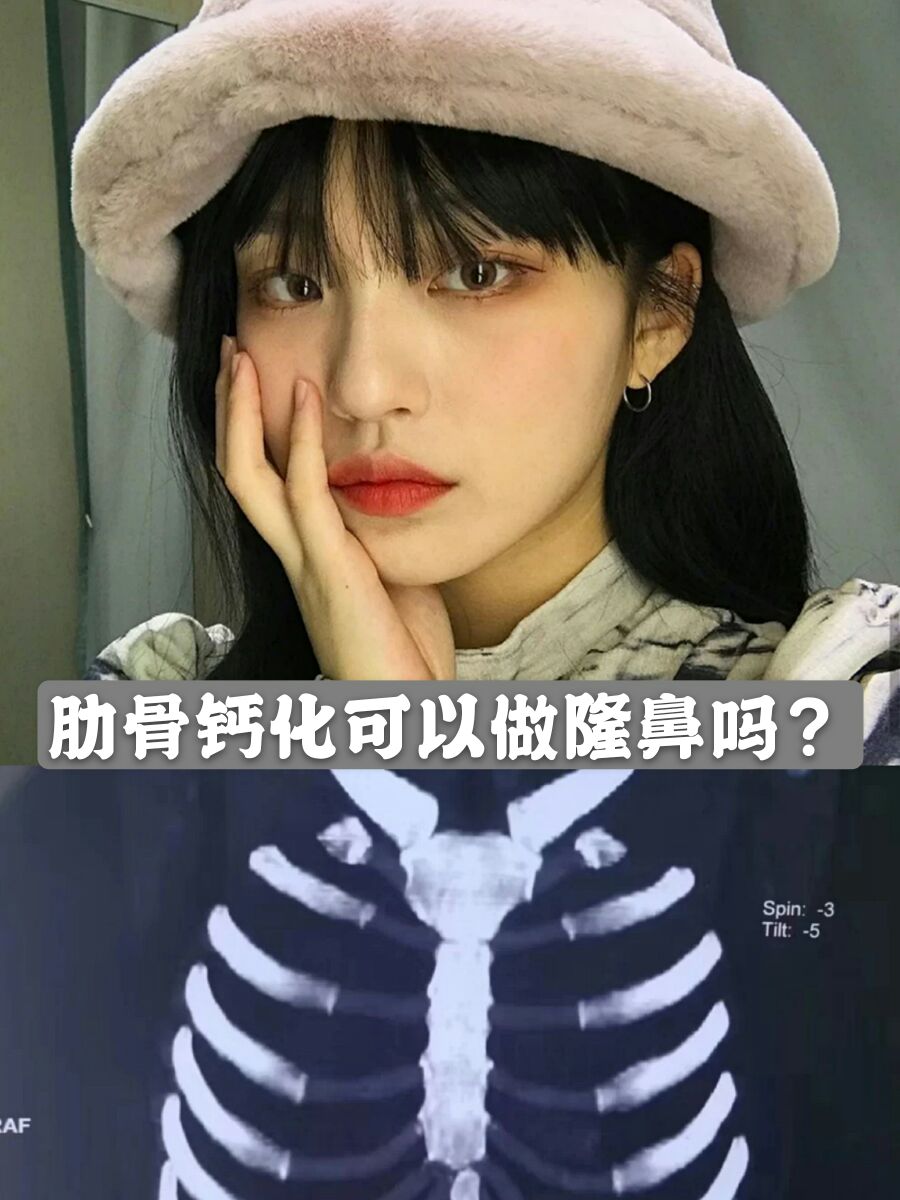 隆鼻怎么知道肋骨有没有钙化,肋骨钙化还能隆鼻吗