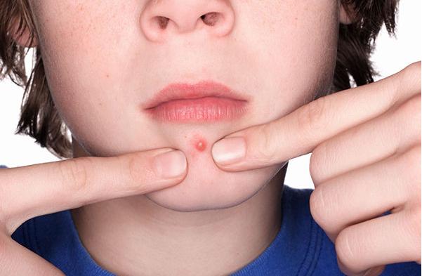 中医后背长痘中成药,背后长痘用什么中药