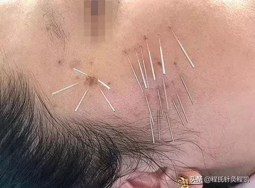 怎么治痘痘痘印最有效的方法,如何治好痘痘痘印最有效