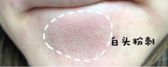 为什么老是长粉刺怎么治疗,老是长闭口粉刺怎么调理