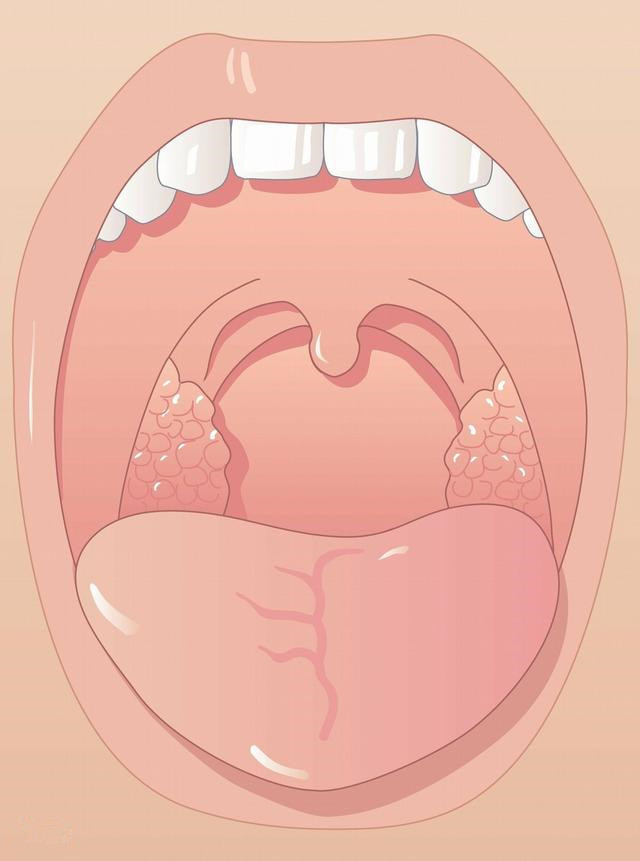 宝宝为什么会扁桃体化脓,为什么宝宝扁桃体容易发炎