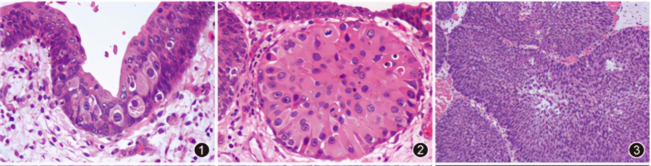 萎缩性胃炎是脾胃虚寒引起的吗,萎缩性胃炎算是严重的胃病吗
