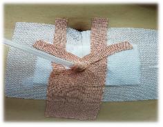 膀胱造瘘管居家护理的ppt,膀胱造瘘后在家如何护理