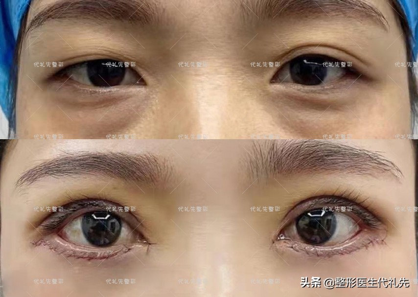 眼睑松弛下垂最佳解决方法,上眼皮松弛显老视频