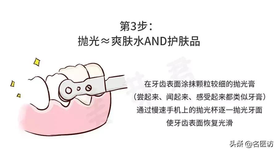 洗牙攻略,洗牙全攻略