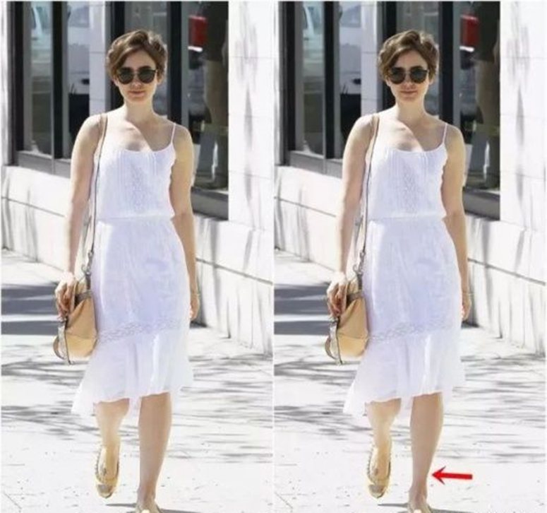 女性腰腹吸脂手术全过程,肥胖的人可以吸脂减肥吗