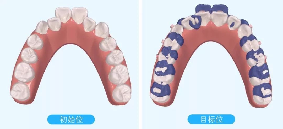 正畸主治学习视频,正畸钟摆效应名词解释