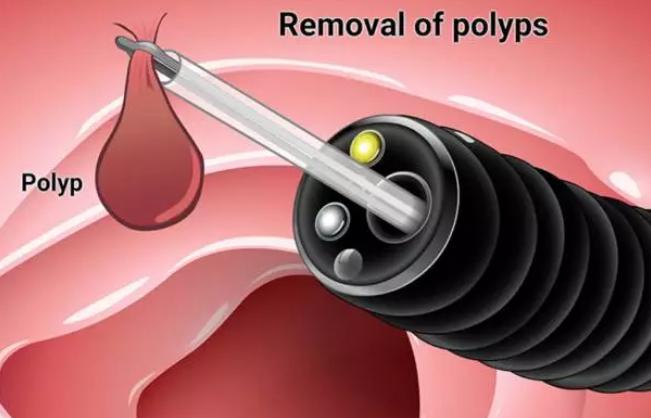 关于肠息肉的5个你最想知道的问题,权威解答来啦