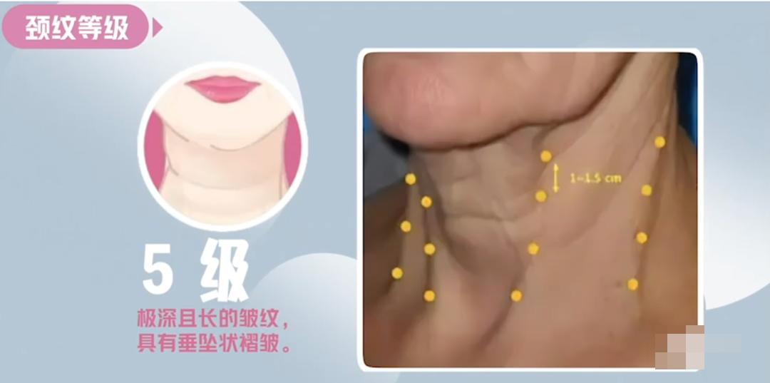 嗨体颈纹针使用方法,嗨体颈纹注射全过程