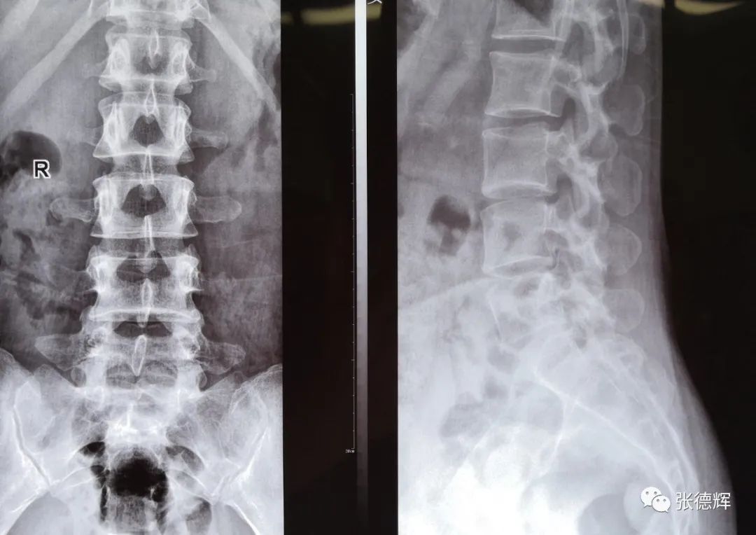 腰椎间盘突出症脊柱内镜微创手术后路镜下视频演示