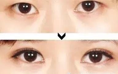 男生割内双眼皮手术,男子去割单眼皮后的结果