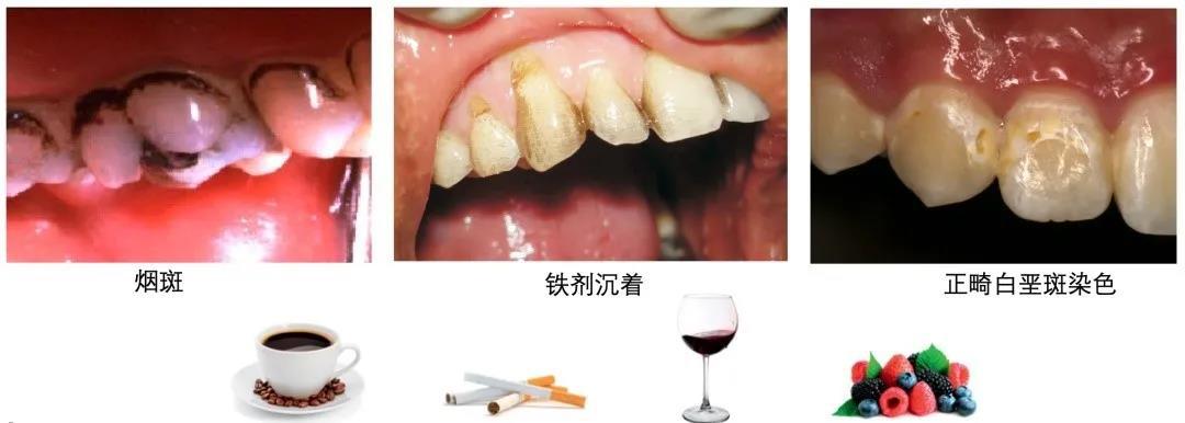 哪个牌子的牙齿美白贴片效果最好,目前最安全有效的牙齿美白