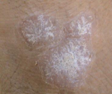 重度银屑病吃苏金单抗,中重度银屑病用什么药物效果最佳