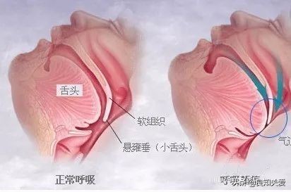 家人突发脑溢血怎么自救,家人脑出血自己如何调整心情