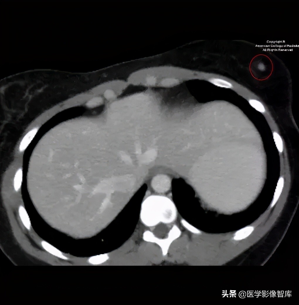 先天性无阴道综合征的影像诊断