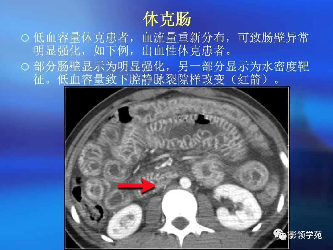 肠道内壁增厚,肠道扩张ct表现