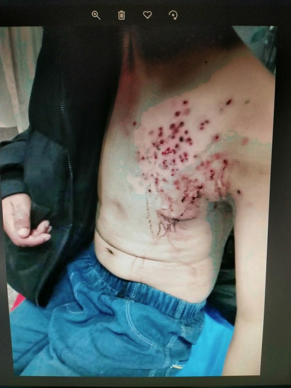 十三岁男孩被火炮爆伤,16岁男孩被枪击中流血如注