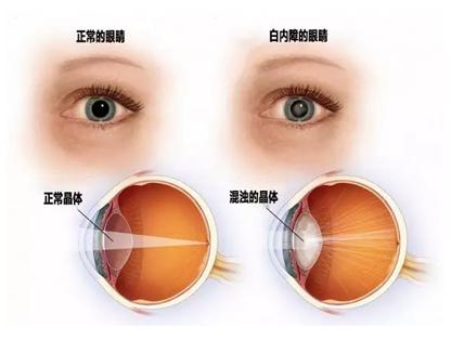 了解白内障的发病率,你了解先天性白内障吗