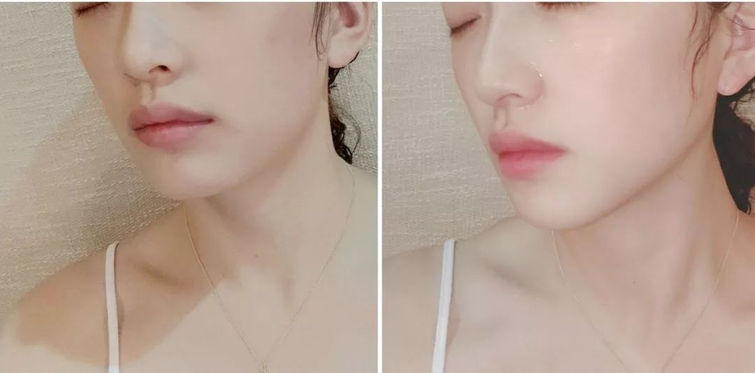 大饼脸用什么减肥方法,减肥圆脸变v字脸效果好吗