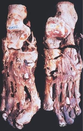 痛风个人经历,痛风的历史渊源与现状