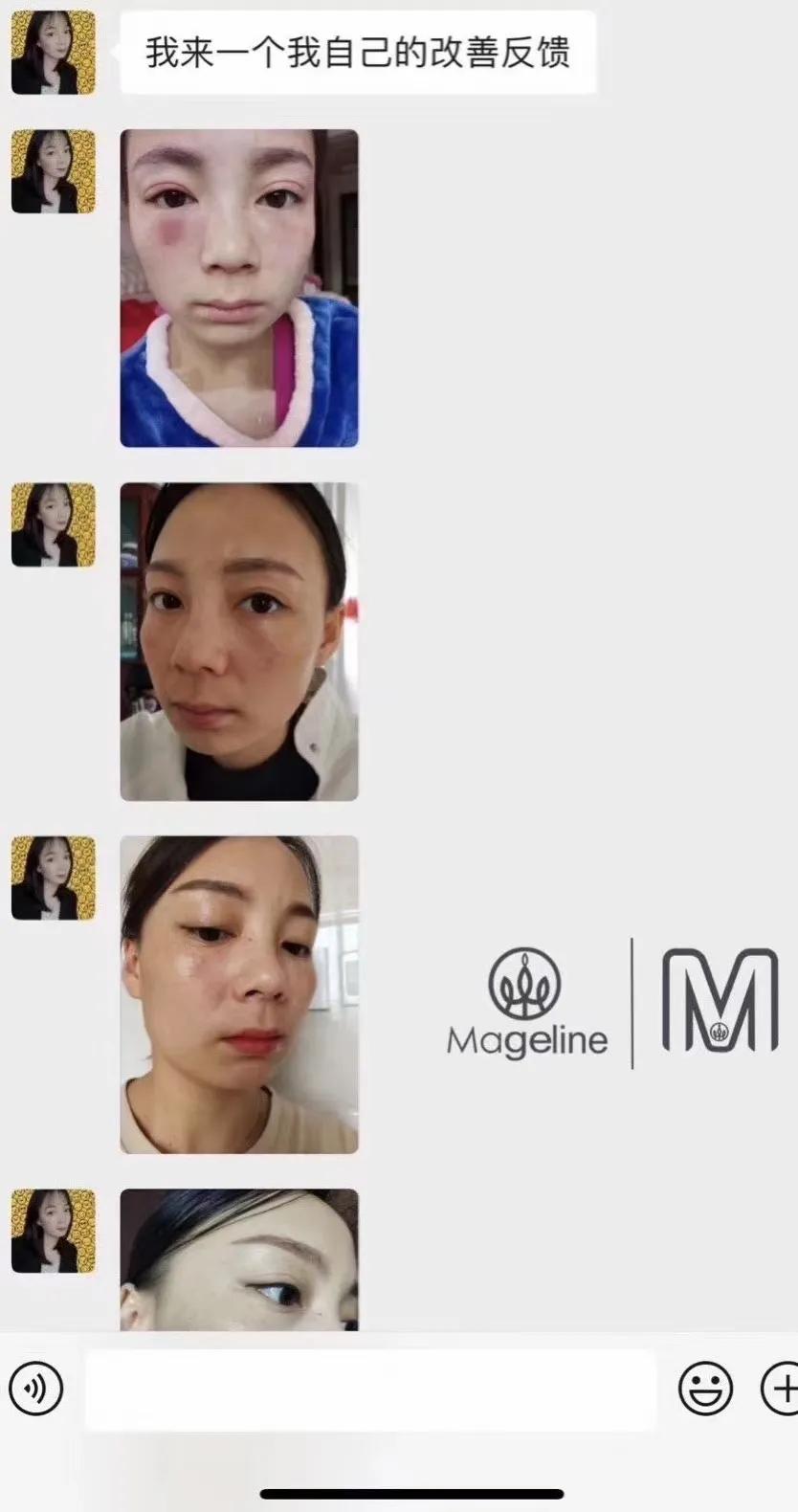 甜甜专业祛斑祛痘,甜甜祛斑直播间