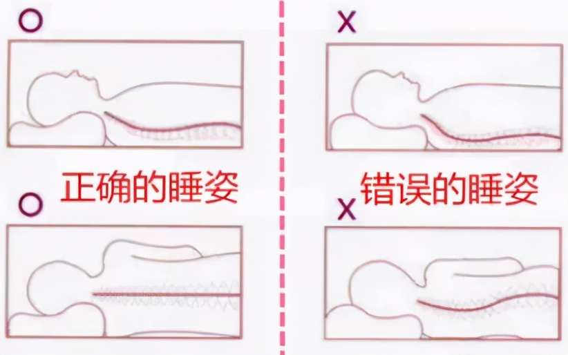 颈椎生理曲度过曲是啥意思,颈椎生理弯曲变直反弓怎么治疗