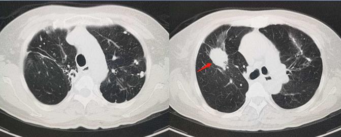 5个小故事：肺结核、脑梗死、车祸，这些意外发现的肺癌都能治