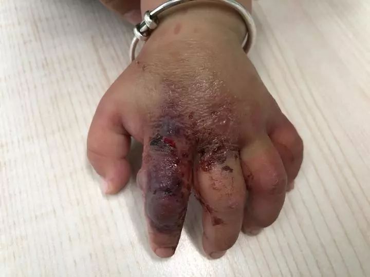 被蚊子咬了快速止痒10种方法,蚊虫叮咬后止痒消肿的妙招抖音