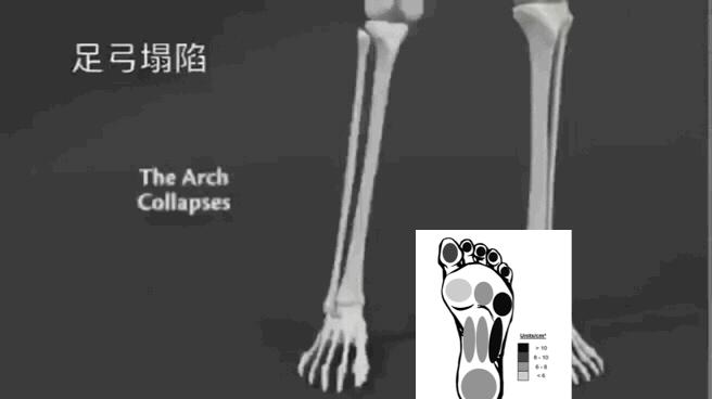 双脚跳跃提高下肢的灵活和协调性,怎么蹲着可以改善o型腿