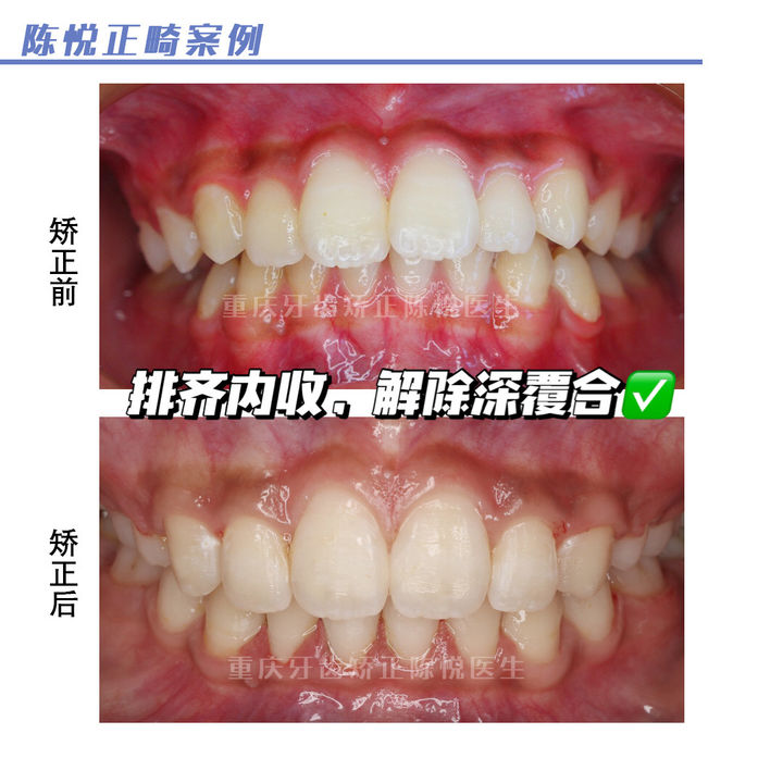 嘴凸深覆合可以自己矫正吗,上海牙齿龅牙矫正
