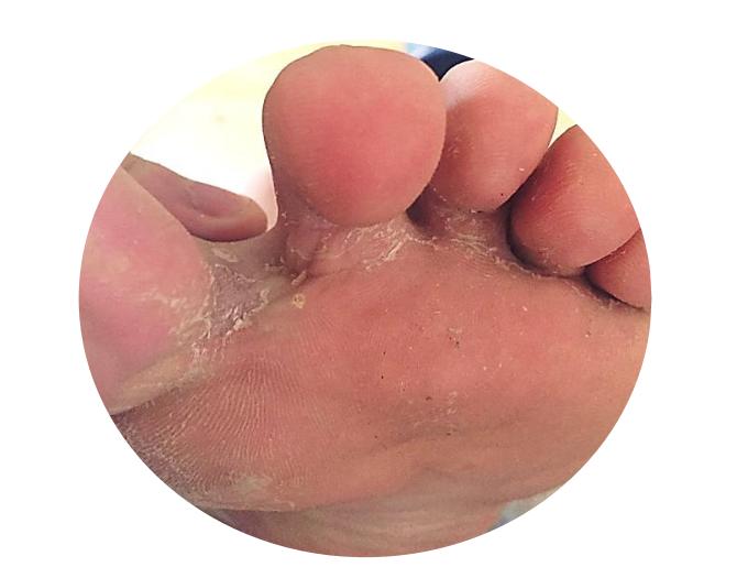 及时治疗脚气，是对家人最好的负责