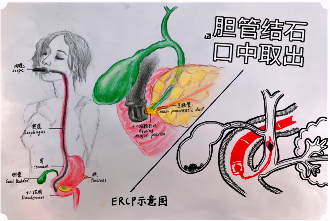 肝内胆管结石微创取石需要住院吗,肝内胆管结石腹腔镜取石