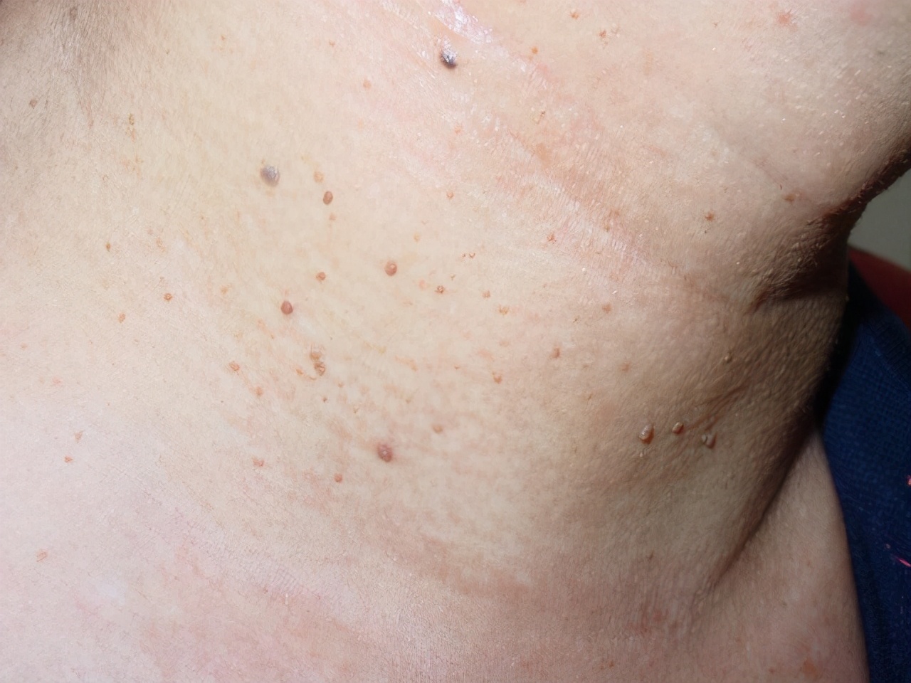 脖子腋下腹股沟长小肉粒怎么去除,腋下脖子上长小肉粒是什么原因