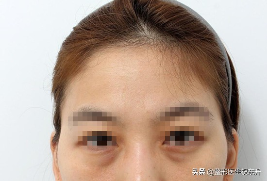 做眼袋去掉脂肪眼袋更松弛了,做眼袋眶隔释放怎么还有泪沟