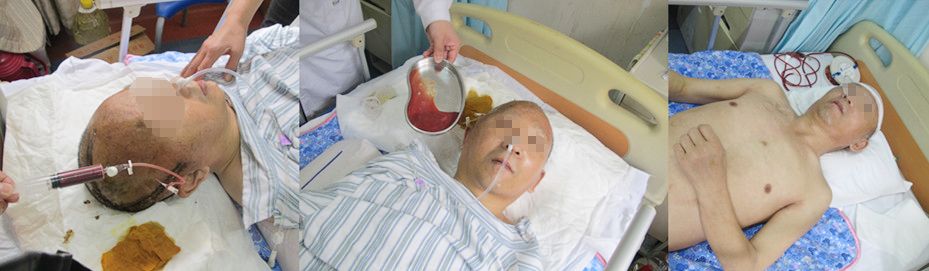 脑外伤开颅手术后脑积水,脑外伤手术后脑脊液鼻漏怎么治疗