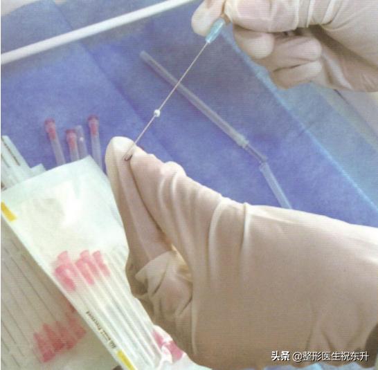 全脸线雕做完即刻提升效果不明显,做完线雕即刻效果不明显