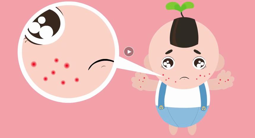 宝宝霜对婴儿湿疹有作用吗,宝宝湿疹可以用婴儿霜