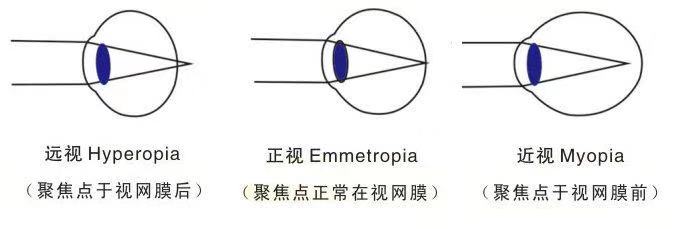 孩子视力0.8严重吗,孩子视力0.6需要矫正吗
