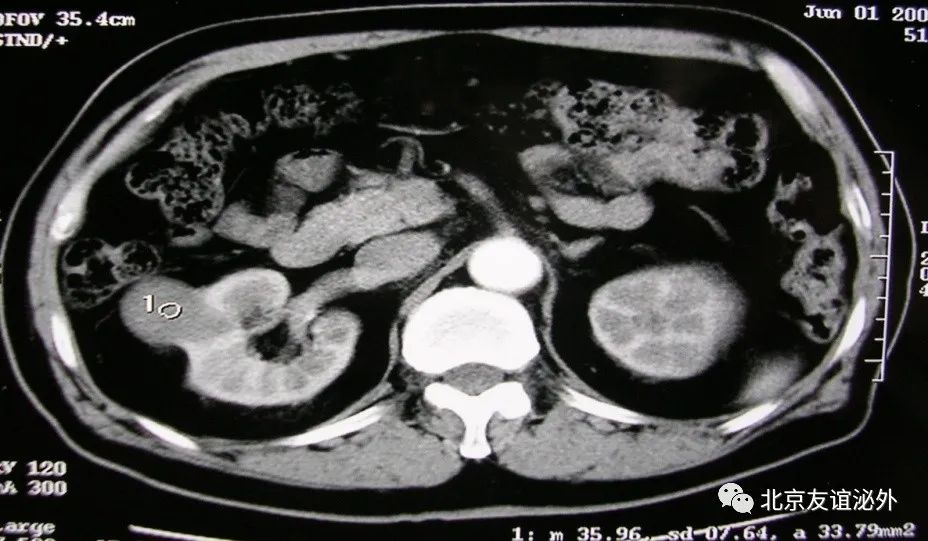 体检发现肾囊肿需不需要做手术,儿童体检发现肾囊肿