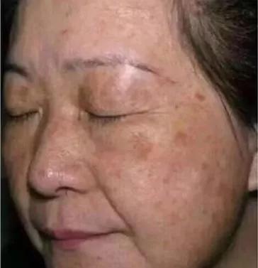 拯救痘痘烂脸用什么药,拯救痘痘烂脸这个小窍门你知道吗