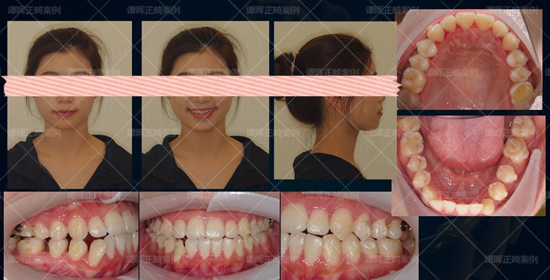 隐适美不拔牙矫正嘴凸,隐适美拔牙矫正三个月有效果吗