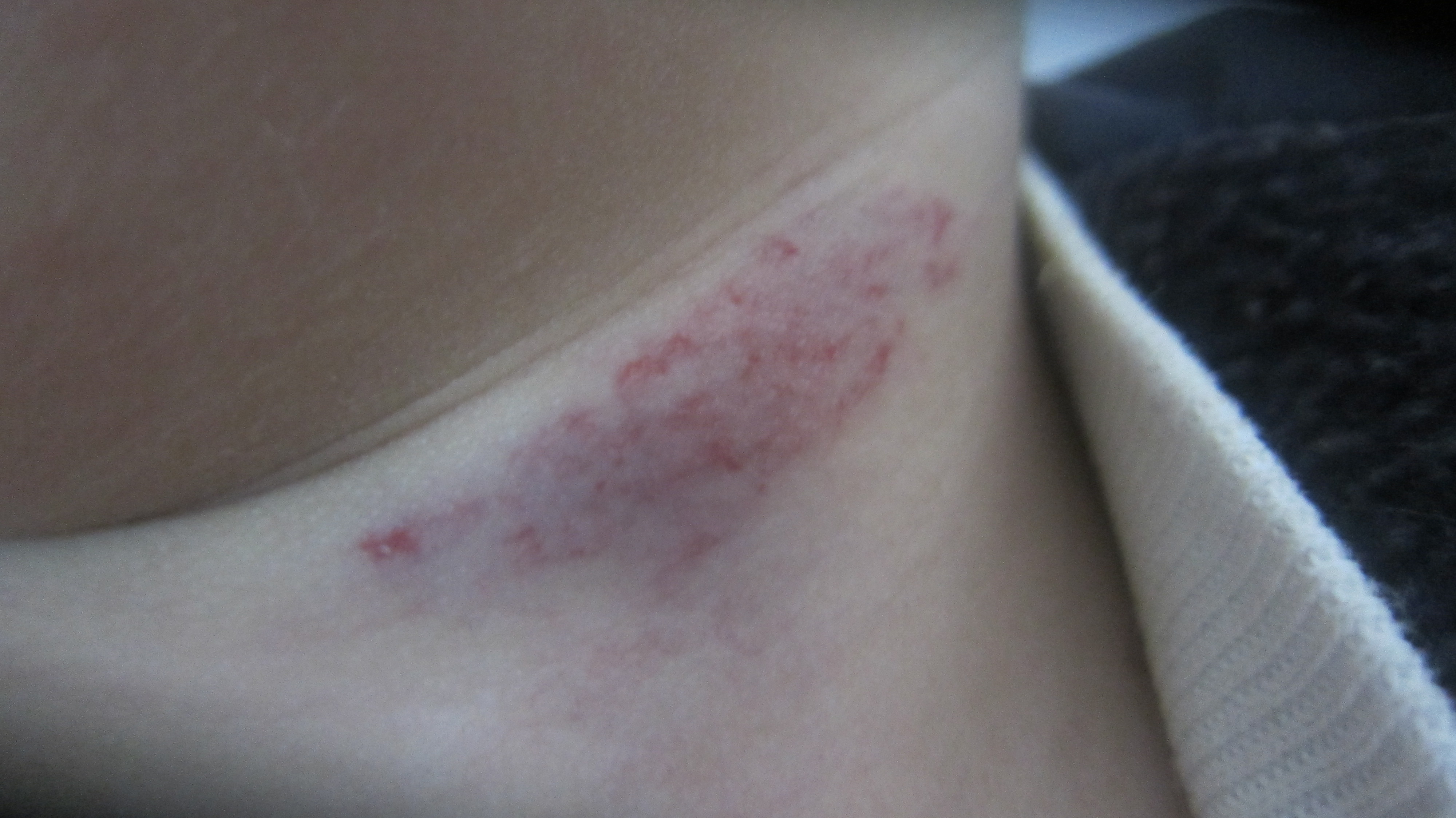 儿童血管瘤怎么治才能彻底根除啊,家长担心孩子的后遗症