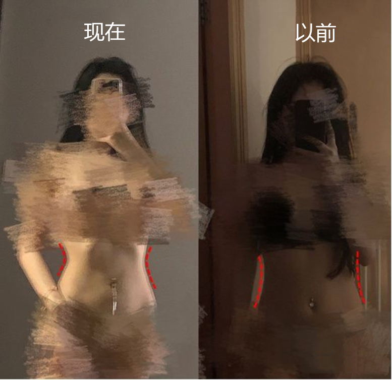 女性腰腹吸脂手术全过程,肥胖的人可以吸脂减肥吗