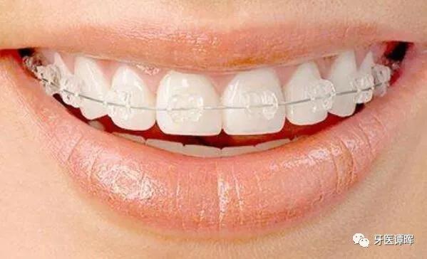 超详细的牙齿矫正过程,重叠牙齿矫正变化过程