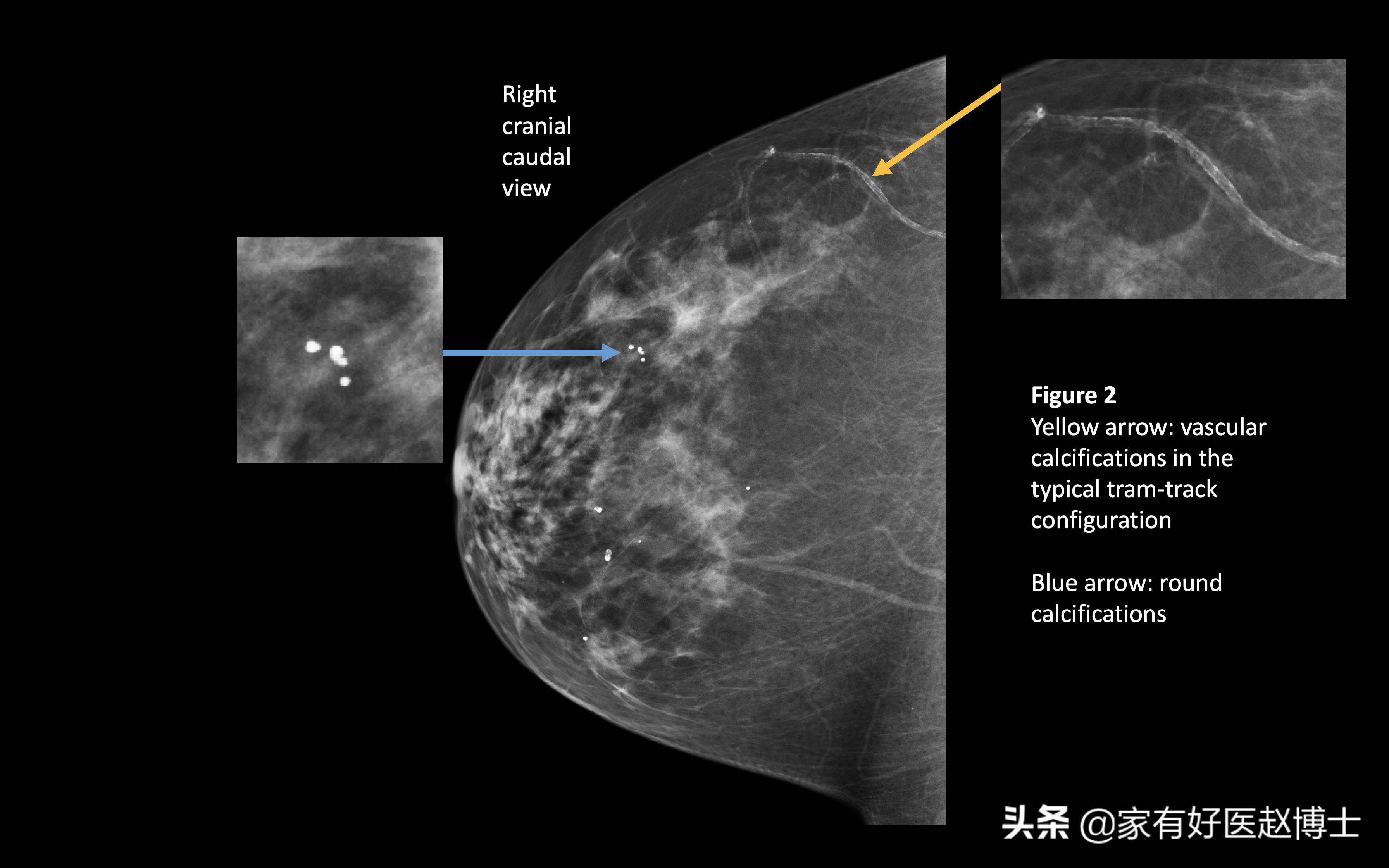 体检报告中常出现钙化哪些需警惕,钙化有什么症状和危害